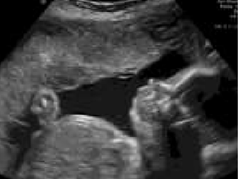 2D fetal ultrasound image
