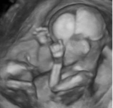 3D fetus ultrasound