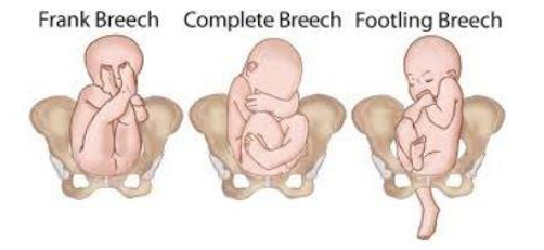 Baby illustrated Breech images