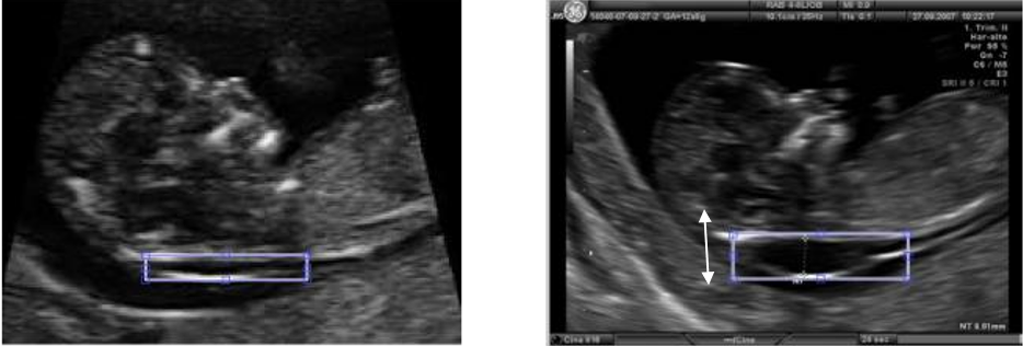 Early Detection of Down Syndrome ultrasound scan