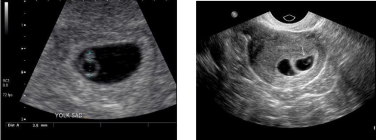 Pregnancy Ultrasound Strata Imaging