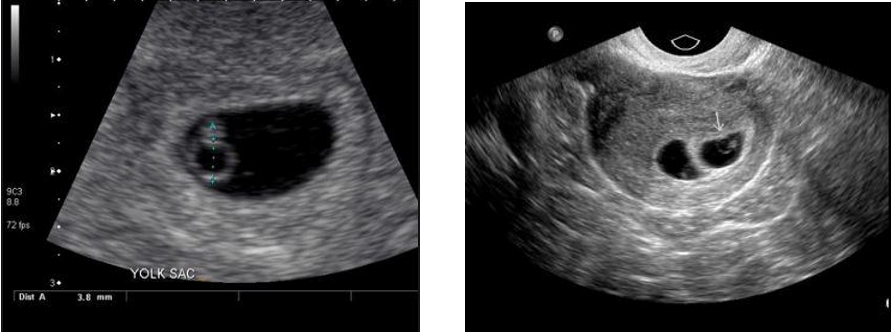 Yolk Sac ultrasound scans