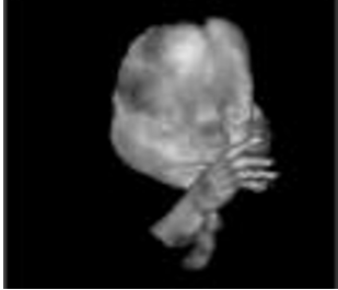 enhanced 3D ultrasound scan