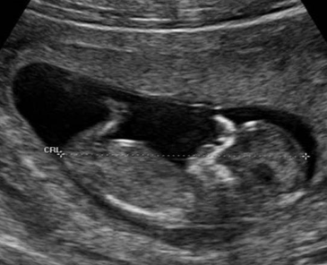 fetus ultrasound scan
