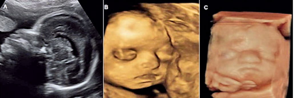 prenatal diagnosis by 2D-3D ultrasound scan