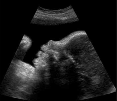 third-trimester ultrasound image